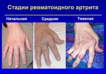 A rheumatoid arthritis és polyarthritis tünetek és betegségek kezelésére