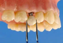 Diabétesz és implantáció