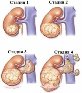 Бъбреци сарком - рядка диагноза със сериозни последици