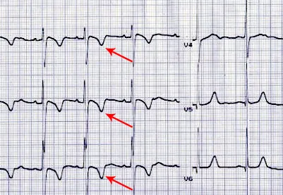 Sindromul de Morgagni-Adams-Stokes - cauze, simptome, diagnostic și tratament