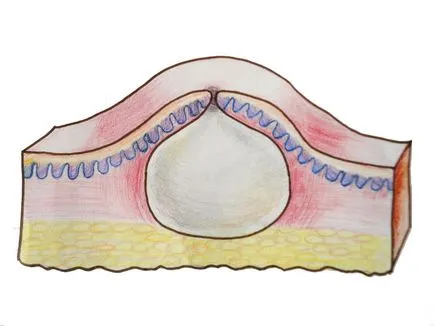 Bump a nyaki gerinc osteochondrosis, lipóma, atheroma és miogeloz