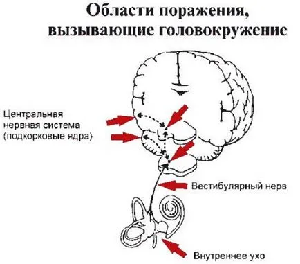 Шум в ушите и световъртеж, причини, лечение, симптоми