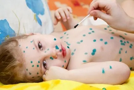 Колко дни налива варицела при деца и възрастни