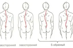 S-образна сколиоза степен