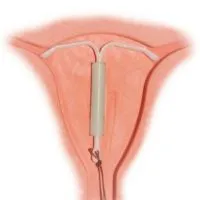 Spiral Mirena in endometrioza