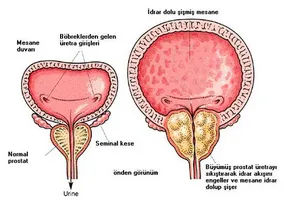 Planificați o recuperare perfectă după îndepărtarea prostatei