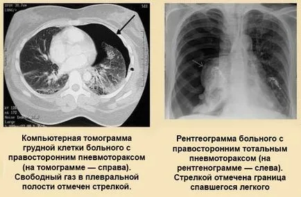 pneumotorax spontan cauze, simptome și tratament