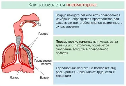Spontán pneumothorax okai, tünetei és kezelése