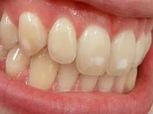 Етап на зъбен кариес