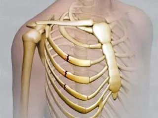 Травма на симптомите на гръдния кош, лечение (снимка)