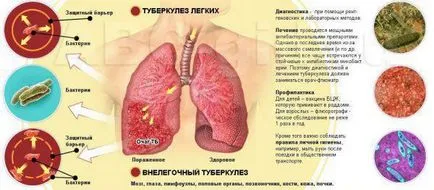 мерки за предотвратяване на болестта туберкулоза, както е докладвано от отворената форма, vozbudshno пускане път,