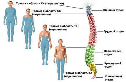 gerincvelő sérülés, és a gerinc (gerincsérülés), tünetei, kezelése, hasznosítása és