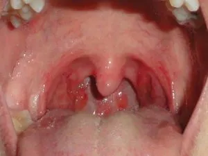 Simptomele faringitei streptococice, tratament (foto)
