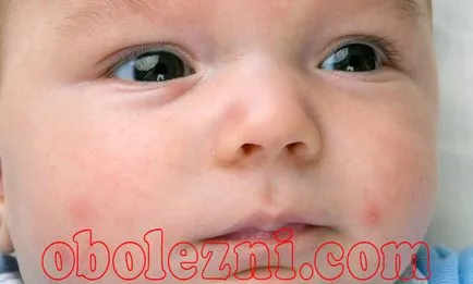 Streptoderma деца - снимка с подробно описание на симптомите