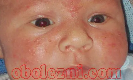 Streptoderma деца - снимка с подробно описание на симптомите