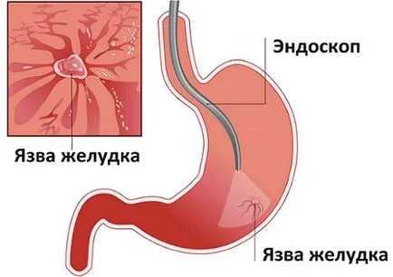 Свещи diklovit простатит какви са плюсовете и минусите на лекарството