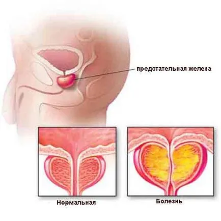 Lumanari diclofenac tratament special pentru prostata