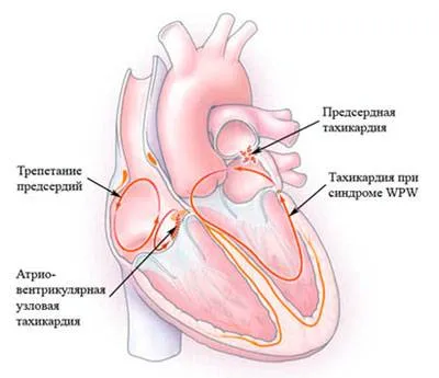 Tachycardia, kardiális tünetek, okok, kezelés, osztályozás