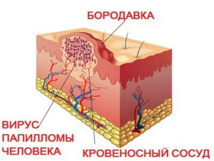 A tablettákat a szemölcsök és papilloma és azok hatékonyságát