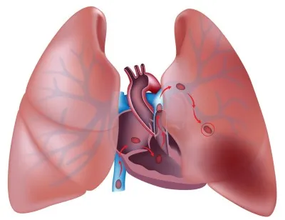 Thrombophlebitis pulmonalis tünetek, a kezelés és a prognózis