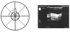 Diagnostic cu ultrasunete de sani fibrochistice difuze - T Trofimova