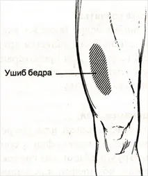 Véraláfutás hip - tünetek és kezelés