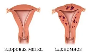 Каква е разликата между аденомиоза и ендометриоза