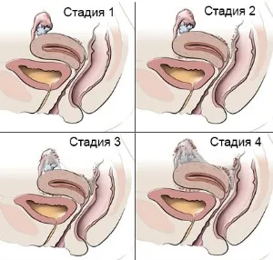 Care este diferența dintre adenomioza si endometrioza