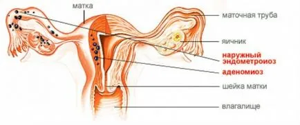 Care este diferența dintre adenomioza si endometrioza