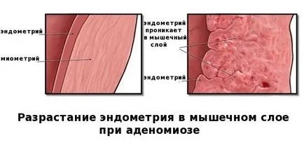 Каква е разликата между аденомиоза и ендометриоза