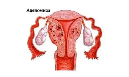 Care este diferența dintre adenomioza si endometrioza