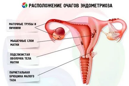 Каква е разликата между аденомиоза и ендометриоза