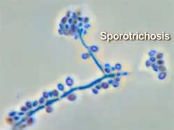 Tipuri de infecții fungice