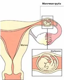 Méhen kívüli terhesség, női egészség