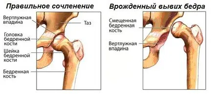 Dislocarea ea, simptome, tipuri, tratament