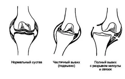 Dislocarea ea, simptome, tipuri, tratament