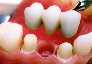 Restaurarea porțiunii coronală de dinți