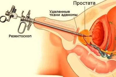 Gyulladás a prosztata adenoma kezelési módszerek és a kábítószer
