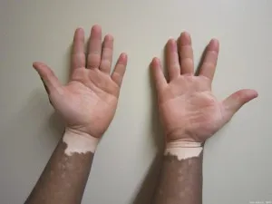 Mind a vitiligo kezelésére Izrael klinikák és központok, a költségek