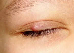 Chalazion горния клепач на детето предизвиква и лечение