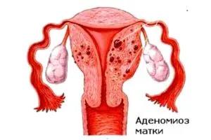 Заболяванията по време на менопаузата при болестта на жените и възпаление на гениталиите