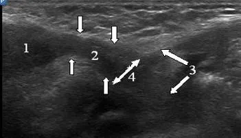 Ultrasunete a canalului inghinal, portalul radiologi