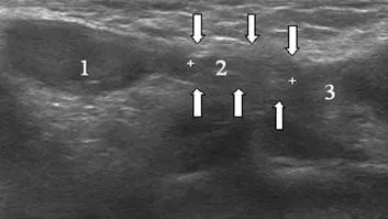 Ultrasunete a canalului inghinal, portalul radiologi