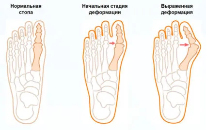 Valgus деформация на големия пръст на крака; рискови фактори, лечението