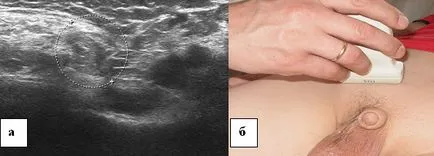 Ultrasunete a canalului inghinal, portalul radiologi