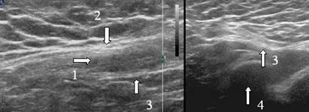 Ultrasunete a canalului inghinal, portalul radiologi