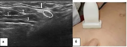 Ultrasunete a canalului inghinal, portalul radiologi