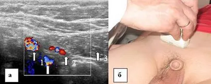 Ultrasunete a canalului inghinal, portalul radiologi