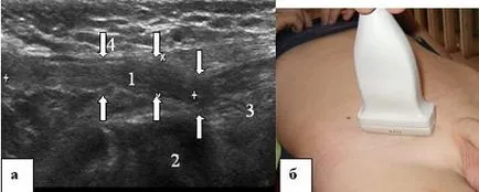 Ultrasunete a canalului inghinal, portalul radiologi