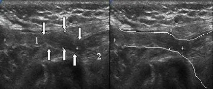 Ultrasunete a canalului inghinal, portalul radiologi